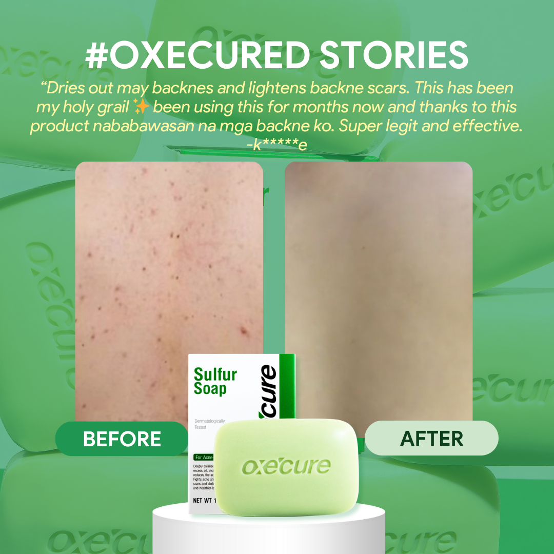 OXECURE Sulfur Soap 100g